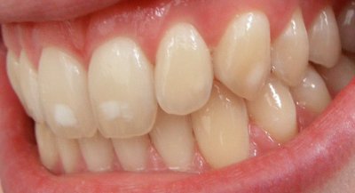 Milde Form der Dentalfluorose